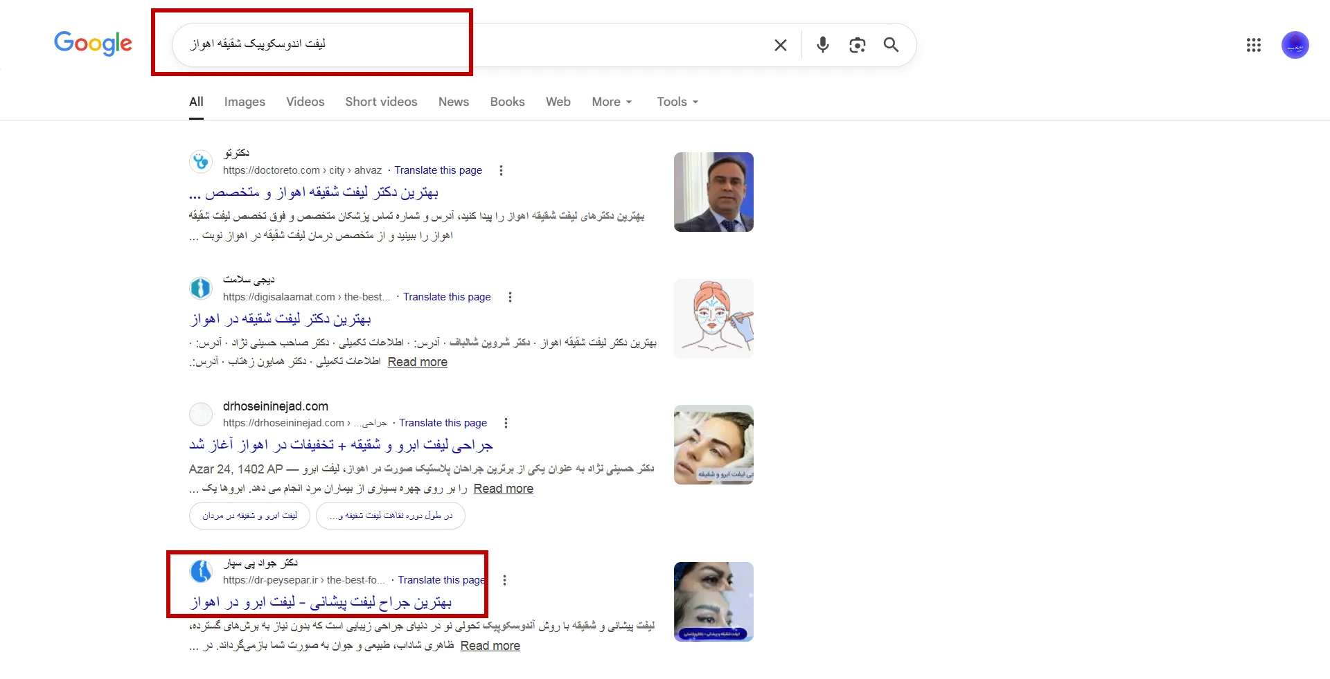 سرچ لیفت آندوسکوپیک شقیقه