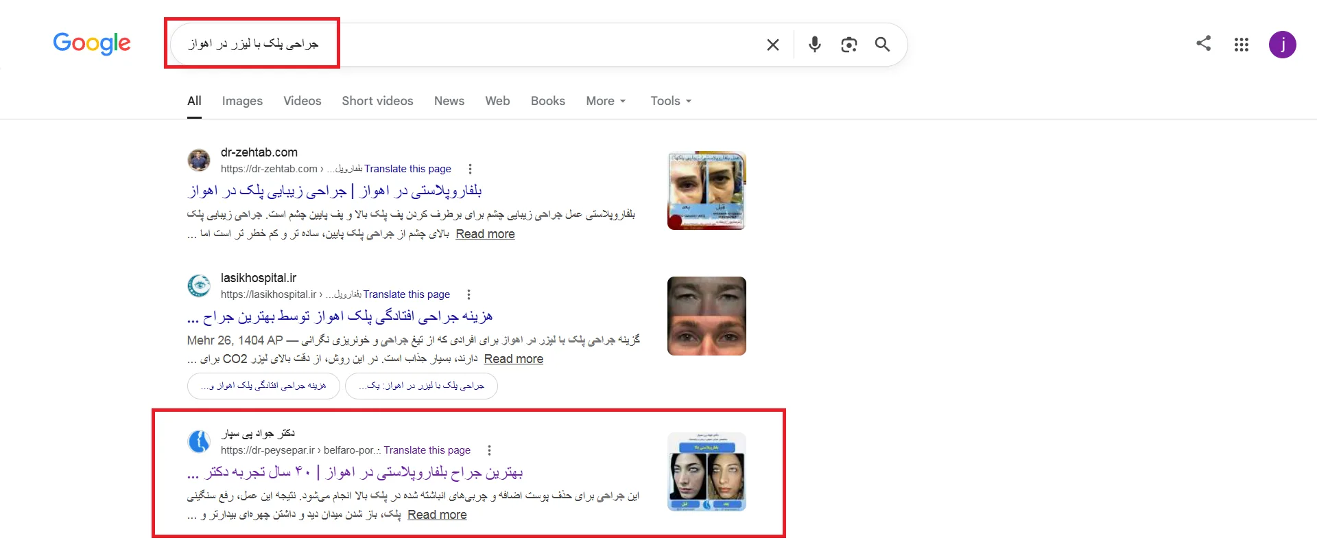 نتیجه سئو سایت دکتر جواد پی سپار جراحی پلک با لیزر در اهواز